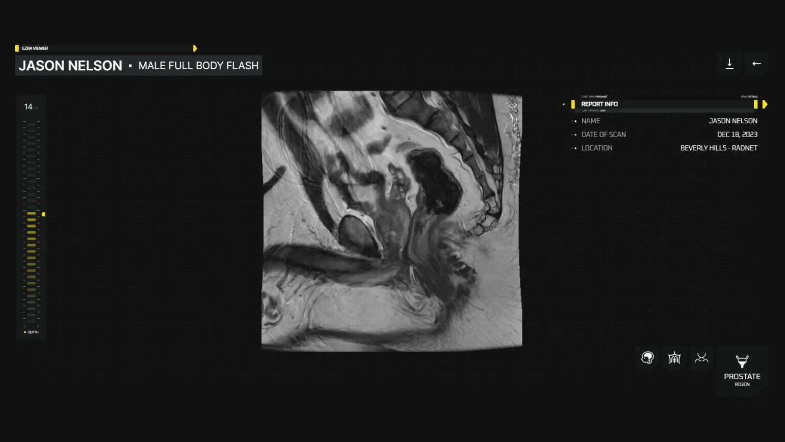 Ezra Scan of Jason's Prostate