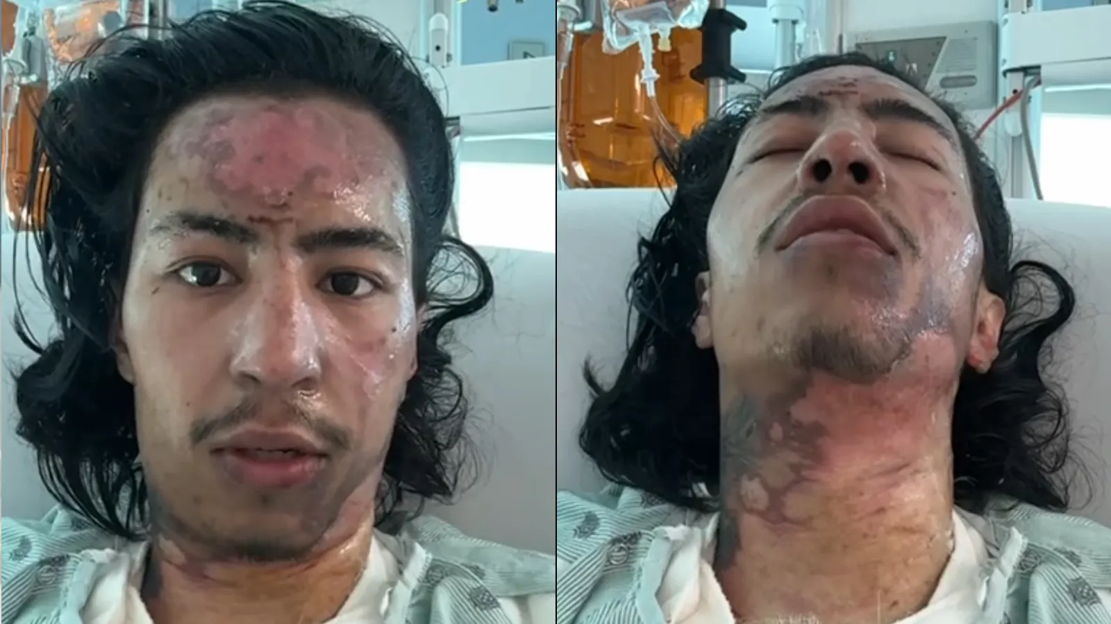 Solana meme coin maker Mikol in the hospital with third-degree burns. Image: Mikol